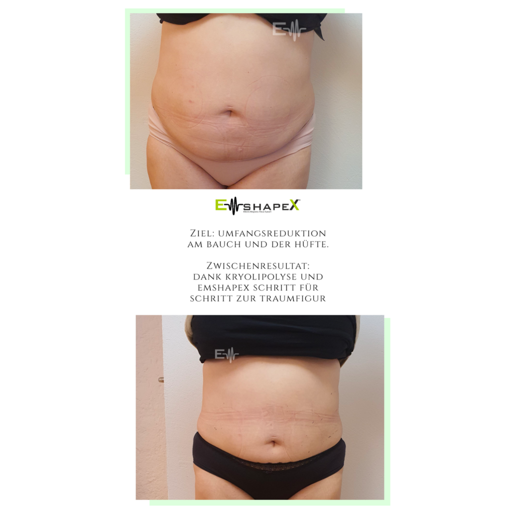 EMShapeX circumference reduction on the abdomen and hips